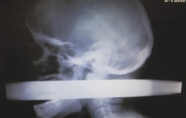 Docs save man after bullet pierces through his skull